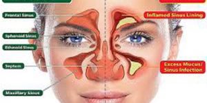 Sinüzit Nedir ve Nasıl Tedavi Edilir?